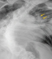 Mechanical Ventilation in Acute Respiratory Distress Syndrome and Severe Scoliosis: A Case Report