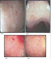 The Role of Duodenal Red Spot Lesions in Screening and Diagnosing Pediatric Celiac Disease
