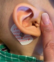 Duplicated External Ear Canal