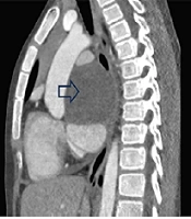 A Large Pericardial Cyst in a Twelve-Year-Old Boy: A Case Report