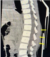 Henoch-Schonlein Purpura with Lumbar Pain and Swelling as the Unusual Presentation in a 6-Year-Old Girl