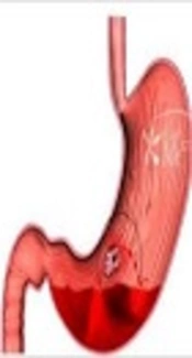 The Importance of Endoscopy as a Useful Method for Diagnosis of Upper Gastrointestinal Bleeding in Children