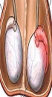 BK Nephropathy in Renal Transplant Patients with Epididymo-Orchitis