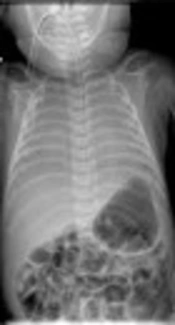 Cover image of the article: Management of Tracheal Agenesis with Esophageal Intubation Can Save Lives: A Reminder for Anaesthesiologist and Neonatologist