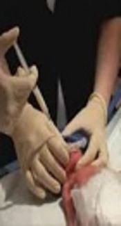 A Randomized Trial Comparing Surfactant Administration Using InSurE Technique and the Minimally Invasive Surfactant Therapy in Preterm Infants (28 to 34 Weeks of Gestation) with Respiratory Distress Syndrome