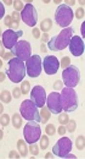 A Comparison of Two Chemotherapeutic Regimes in Children with B-Cell Acute Lymphoblastic Leukemia
