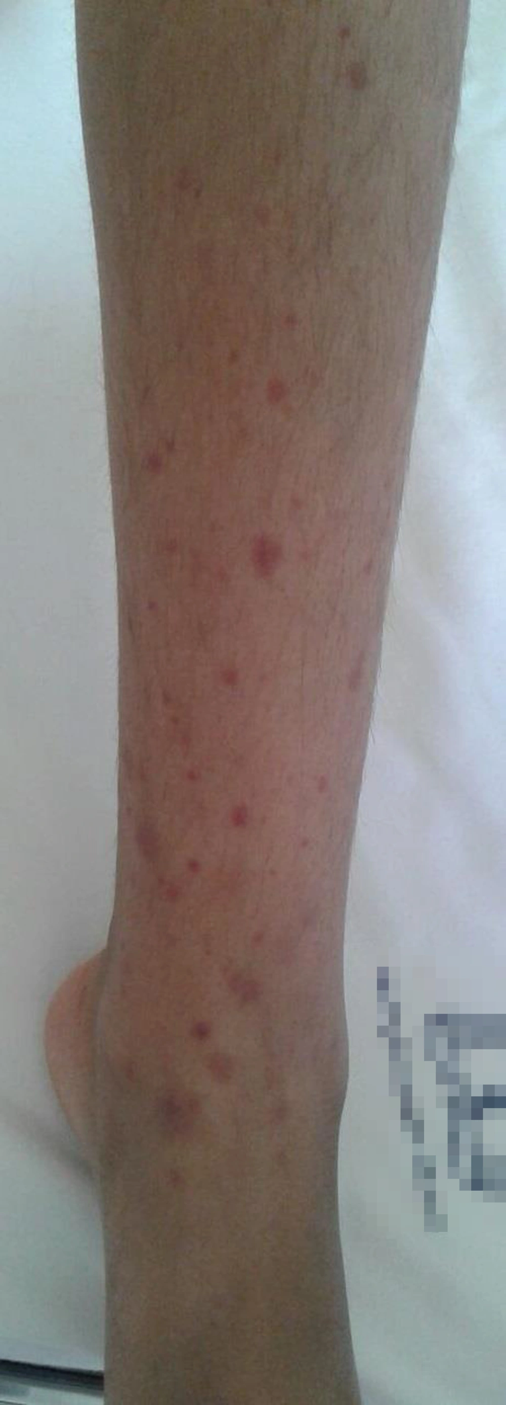 Palpable erythematous papules and purpura Palpable erythematous papules and purpura