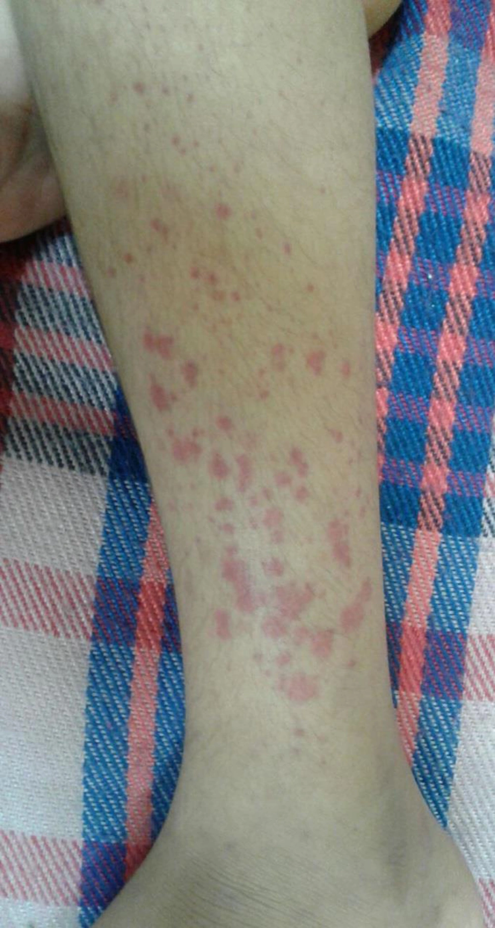 Palpable erythematous papules and purpura Palpable erythematous papules and purpura