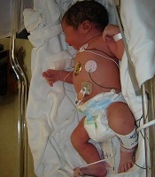The Prediction of Mortality Risk in Preterm Infants Hospitalized in the Neonatal Intensive Care Unit Using SNAPPE-II Score System