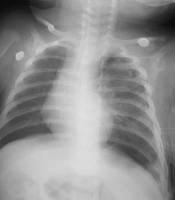 A Multidisciplinary Approach to Manage of a Recurrent Congenial Diaphragmatic Hernia; A Case Report