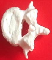 The Characteristics of Nitinol in Spinal Implant Manufacturing