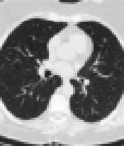 Cover image of the article: Epidemiological, Clinical and Imaging Features of 2019 Novel Coronavirus Diseases (COVID-19) in Southwestern Iran: A Descriptive Study