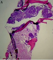Diagnostic Challenges in Detecting Gastrointestinal Cancer Presented with Bicytopenia, Report of Two Cases and Review of Literature