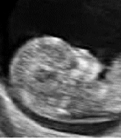 Fetal Weight Percentile Classification Across Gestational Weeks by Comparing Machine-Learning Algorithms Using Ultrasound Images