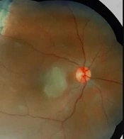 Spontaneous Separation of Secondary Epiretinal Membrane (ERM) with Retinal Tear After Retinal Laser Photocoagulation