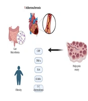 Poly Cystic Ovary Syndrome (PCOS): Inflammation, Hormonal Imbalance, Cardiovascular Risks, and Metabolic Factors