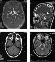 Isolated Third Nerve Palsy Associated with Herpes Zoster: A Case Report