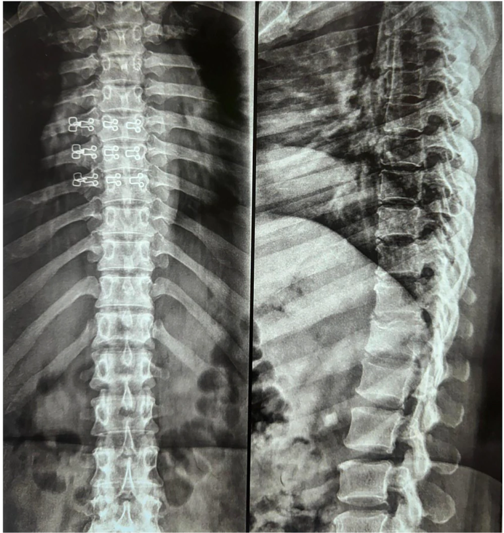 X-ray of the thoracic and lumbar spine X-ray of the thoracic and lumbar spine