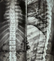 Beyond Inflammation: Early Thoracic and Lumbar Spine Involvement in a Young Patient with Rheumatoid Arthritis