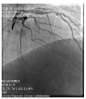 Evaluation of Drugs and Strategies for Treating Coronary Artery Ectasia: Update and Future Perspective