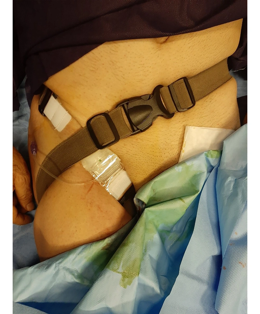 Femostop at the femoral puncture site Femostop at the femoral puncture site