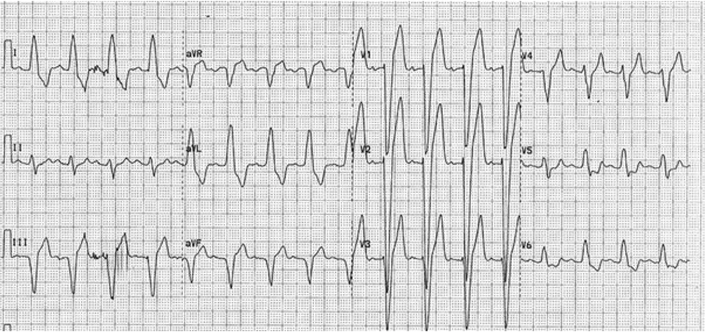 Electrocardiogram of left bundle branch block (LBBB) with smooth QRS complex (sQRS). In addition to the wideness of the QRS complex, no additional prominent notch are observed in the descending and ascending parts of the complex. Electrocardiogram of left bundle branch block (LBBB) with smooth QRS complex (sQRS). In addition to the wideness of the QRS complex, no additional prominent notch are observed in the descending and ascending parts of the complex.