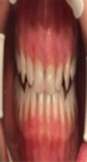 Comparative Evaluation of Gingival Depigmentation and Recurrence Using 810 Nm Diode Laser and Cryosurgery (Clinical Trial Study)
