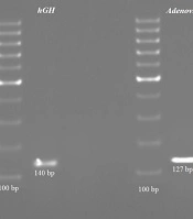 The Association Between Adenovirus Infection and Irritable Bowel Syndrome: A Case-Control Study in Iran