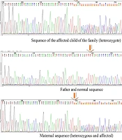 Study of Muscular Dystrophy (TTN Gene) in One Family from Khuzestan Using Whole Exome Sequencing