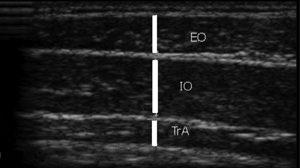 Ultrasound Measurement of the Abdominal Muscles Thickness TVA, transverse abdominis; IO, internal oblique; EO, external oblique