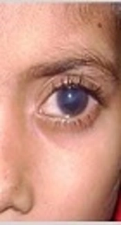 The Role of Genetic Counseling in Prevention of Primary Congenital Glaucoma