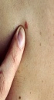 Prevalence of Skin Cancer in Isfahan Province, Iran