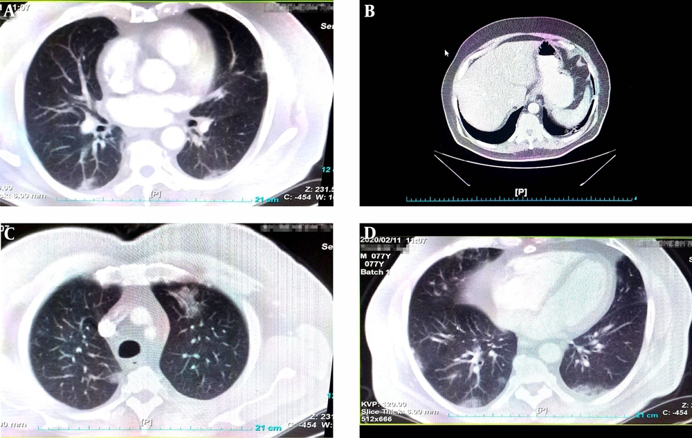 Chest CT scan (transverse plane) of 74-year-old man with COVID-19 as revealed bilateral peripheral ground glass, crazy paving and small consolation opacities Chest CT scan (transverse plane) of 74-year-old man with COVID-19 as revealed bilateral peripheral ground glass, crazy paving and small consolation opacities