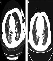 Cover image of the article: The Use of Moxisaxin for Treatment of a Decompensated Cirrhosis Patient with Severe Pulmonary Infection
