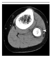 Acute Hematogenous Escherichia coli Osteomyelitis of the Fibula in an Adolescent Girl