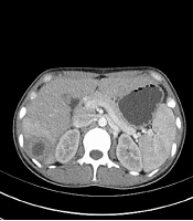 Liver Abscess Caused by Fusobacterium nucleatum: A Case Report