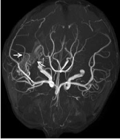 Successful Treatment of Postneurosurgical Ventriculitis Caused by Extensively Drug-resistant Acinetobacter baumannii in a Child: Case Report