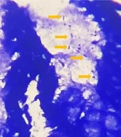 Comparing Diagnostic Accuracy of the fliD Gene and the glmM Gene in Helicobacter pylori