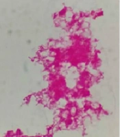 Streptobacillus moniliformis Bacteremia in a Patient with Reactive Arthritis Without a Bite: A Case Report