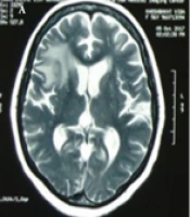 A Case-report of Concurrent Pulmonary and Cerebral Lesions in a Patient with Polymyositis: Invasive Aspergillosis or Astrocytoma?