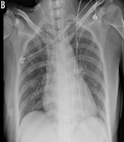 Combination Therapy with Ceftazidime-Avibactam and Amikacin for Multidrug-Resistant Pseudomonas aeruginosa Infection with Fulminant Myocarditis in a Younger Patient: A Case Report and Literature Review