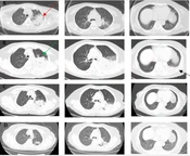 A Case of Chlamydophila psittaci Caused Pneumonia and Encephalitis Diagnosed by Metagenome Next-Generation Sequencing and Clinical Analysis