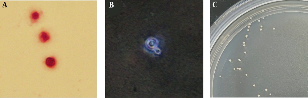 The microscopic morphology of <i>Cryptococcus</i> after different staining techniques was examined. A, after Gram staining, some circular yeast like fungi were found under the microscope; B, pink staining revealed a thick capsule surrounding the pathogen; C, white smooth colonies grow at 37℃ after CSF inoculation. The microscopic morphology of <i>Cryptococcus</i> after different staining techniques was examined. A, after Gram staining, some circular yeast like fungi were found under the microscope; B, pink staining revealed a thick capsule surrounding the pathogen; C, white smooth colonies grow at 37℃ after CSF inoculation.