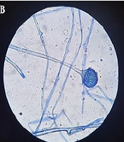 COVID-19 Associated Mucormycosis and Risk Factors: A Case-Control Study from Turkey