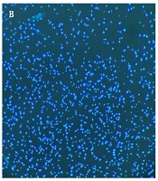 First Report of Candida auris Isolated from a Patient with Severe Pneumonia in Zhejiang, China