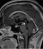 A Case of HIV-Related Cerebral Toxoplasmosis with Hydrocephalus and Literature Review