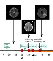 A Successful Management of Concurrent Infection with Cranial Nocardia gipuzkoensis and Pulmonary Klebsiella pneumoniae: A Case Report