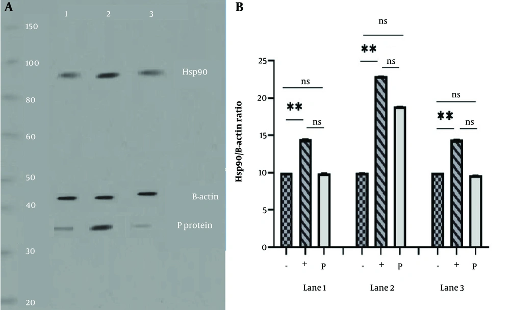 A, heat shock protein 90 (Hsp90) overexpression challenge virus standard-11 (CVS-11) infected cells; lane 1, neuro2a (N2a) cells were transfected with the pCI-neo empty vector before infection. Visible bands correspond to the expression of Hsp90 and rabies P protein in cell lysates at 24 hours post-infection (hpi). Lane 2, cells were transfected with pCI-neo-Hsp90, and cell lysate blotting analysis showed strong bands for Hsp90 and P protein at 48 hpi. Lane 3, N2a cells were inoculated with the rabies virus (RABV), exposed to PF-573,228 (1 μM) two hours later, and checked at 48 hpi. It had no effect on Hsp90 expression. The low expression of the P protein is also due to the additional effect of Hsp90 and cell division cycle 37 (Cdc37) chaperones, as the inhibitor blocks focal adhesion kinase (FAK). β-actin is considered a control protein; B, quantitative analysis of Hsp90 overexpression and β-actin, in cells infected with CVS-11 and exposed to PF-573,228 (1 μM) at 48 hpi; lane 1, normal N2a cells were transfected with a pCI-neo empty vector before RABV infection. Western blot analysis of cell lysate at 24 hpi showed significant differences between β-actin and Hsp90. The (+) sign indicates the presence of Hsp90 and the (-) sign indicates the absence of Hsp90 (** P < 0.01). Lane 2, cells were transfected with pCI-neo-Hsp90, and cell lysate blot analysis revealed significant differences between β-actin and Hsp90 (** P < 0.01) at 48 hpi. Lane 3, N2a cells were infected with the RABV, exposed to PF-573,228 (1 μM) for two hours, and checked at 48 hpi. Although it had no effect on the P protein expression, it caused a significant difference between β-actin and Hsp90 (** P < 0.01). The low expression of the P protein is also due to the accessory effect of Hsp90 and Cdc37 chaperones, as the inhibitor blocked FAK. β-actin is considered a control protein. A, heat shock protein 90 (Hsp90) overexpression challenge virus standard-11 (CVS-11) infected cells; lane 1, neuro2a (N2a) cells were transfected with the pCI-neo empty vector before infection. Visible bands correspond to the expression of Hsp90 and rabies P protein in cell lysates at 24 hours post-infection (hpi). Lane 2, cells were transfected with pCI-neo-Hsp90, and cell lysate blotting analysis showed strong bands for Hsp90 and P protein at 48 hpi. Lane 3, N2a cells were inoculated with the rabies virus (RABV), exposed to PF-573,228 (1 μM) two hours later, and checked at 48 hpi. It had no effect on Hsp90 expression. The low expression of the P protein is also due to the additional effect of Hsp90 and cell division cycle 37 (Cdc37) chaperones, as the inhibitor blocks focal adhesion kinase (FAK). β-actin is considered a control protein; B, quantitative analysis of Hsp90 overexpression and β-actin, in cells infected with CVS-11 and exposed to PF-573,228 (1 μM) at 48 hpi; lane 1, normal N2a cells were transfected with a pCI-neo empty vector before RABV infection. Western blot analysis of cell lysate at 24 hpi showed significant differences between β-actin and Hsp90. The (+) sign indicates the presence of Hsp90 and the (-) sign indicates the absence of Hsp90 (** P < 0.01). Lane 2, cells were transfected with pCI-neo-Hsp90, and cell lysate blot analysis revealed significant differences between β-actin and Hsp90 (** P < 0.01) at 48 hpi. Lane 3, N2a cells were infected with the RABV, exposed to PF-573,228 (1 μM) for two hours, and checked at 48 hpi. Although it had no effect on the P protein expression, it caused a significant difference between β-actin and Hsp90 (** P < 0.01). The low expression of the P protein is also due to the accessory effect of Hsp90 and Cdc37 chaperones, as the inhibitor blocked FAK. β-actin is considered a control protein.