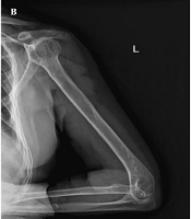 A Rare Case of Chronic Osteomyelitis of the Left Humerus Caused by Aerococcus viridans