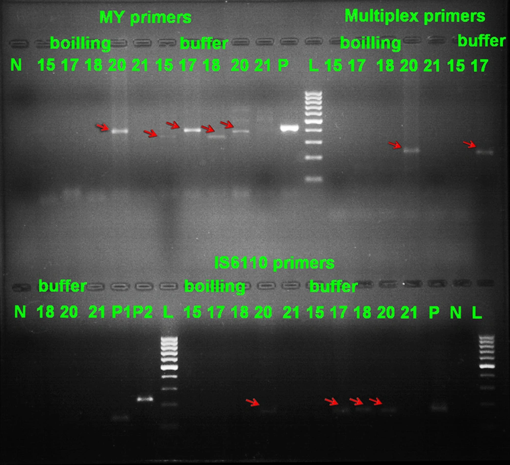 Representative Agarose Gel of PCR Products With All Four Sets of (MYITS, MTC, NTM and IS6110) Primers With Two DNA Extraction (Boiling and Buffer) Methods. Lane N: negative control; Lane 15, 17, 18, 21: negative samples with MYITS primers and boiling method; Lane 20 (around 400bp): positive sample with MYITS primers and boiling method; Lane 21: negative sample with MYITS primers and buffer method; Lane 15, 17, 18, 20 (around 350, 400, 350, 400 bp respectively): positive samples with MYITS primers and buffer method; Lane P: positive control for MYITS primers; Lane L: 100 bp DNA marker (Fermentas); Lane 15, 17, 18, 21: negative samples with MTC and NTM primers and boiling method; Lane 20 (around 235 bp): positive sample (MTC) with MTC and NTM primers and boiling method; Lane 15, 18, 20, 21: negative samples with MTC and NTM primers and buffer method; Lane 17 (around 235 bp): positive sample (MTC) with MTC and NTM primers and buffer method; Lane P1: positive control for <i>Mycobacterium tuberculosis</i> complex (MTC) strains; Lane P2: positive control for non-tuberculous mycobacteria (NTM) strains; Lane 15, 17, 18, 21: negative samples with IS6110 primers and boiling method; Lane 20 (around 150 bp): positive sample with IS6110 primers and boiling method; Lane 15, 21: negative samples with IS6110 primers and buffer method; Lane 17, 18, 20 (around 150 bp) positive samples with IS6110 primers and buffer method; Lane P: positive control for IS6110 primers; Lane N: negative control for IS6110 primers.